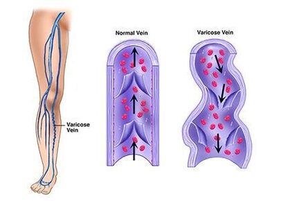 Neoveris prevents the development of venous pathologies