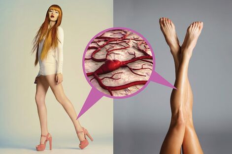Varicose veins on the legs