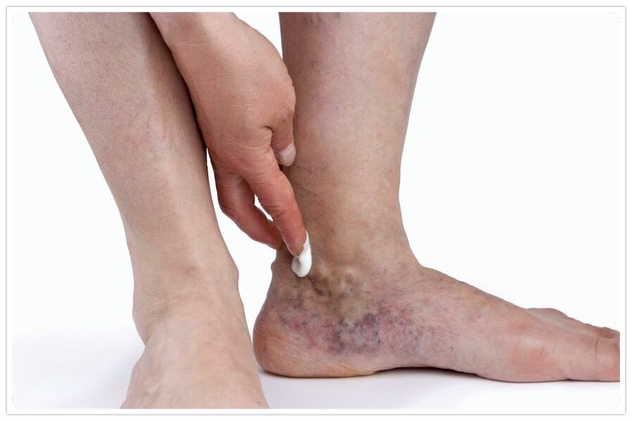 The advantages of the procedure for the veins