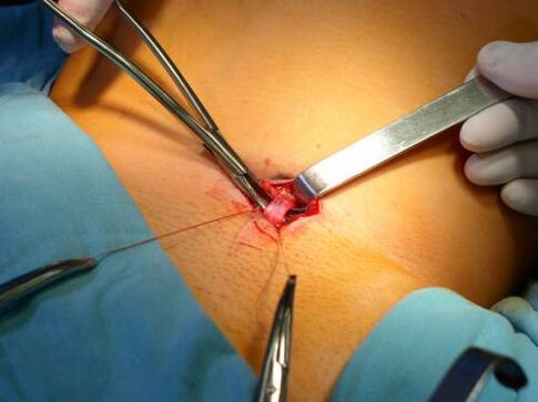 Flobectomy