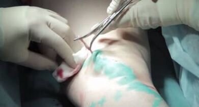 Surgery