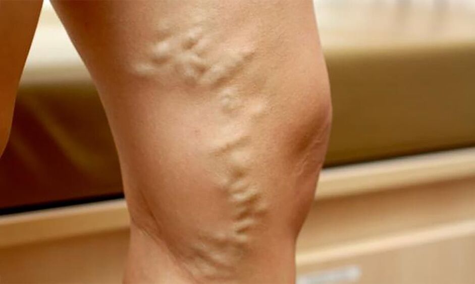 Varicose veins on the leg