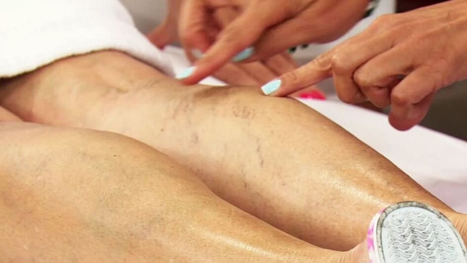 Varicose veins on the lower part of the leg