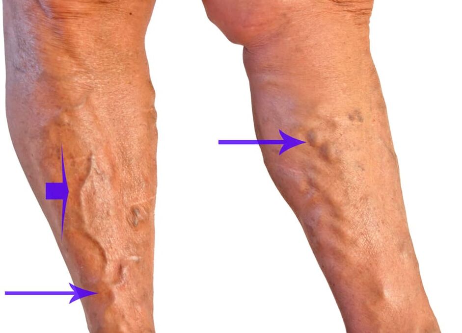 Varicosi nodes