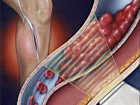 Deep vein thrombosis