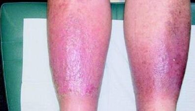 third stage of varicose veins on the legs