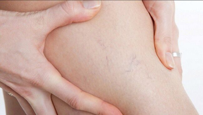 Varicose veins on the legs are a sign of varicose veins