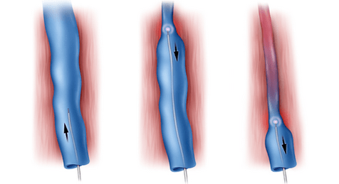 Radiofrequency ablation is a method for treating varicose veins