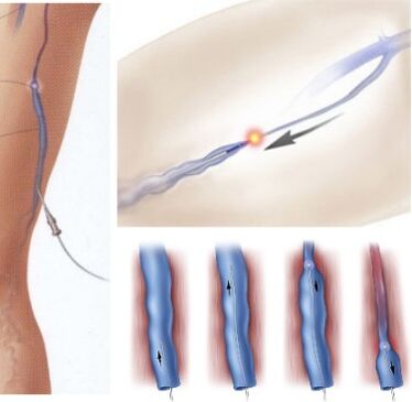 method of treatment of varicose veins - endovenous laser coagulation