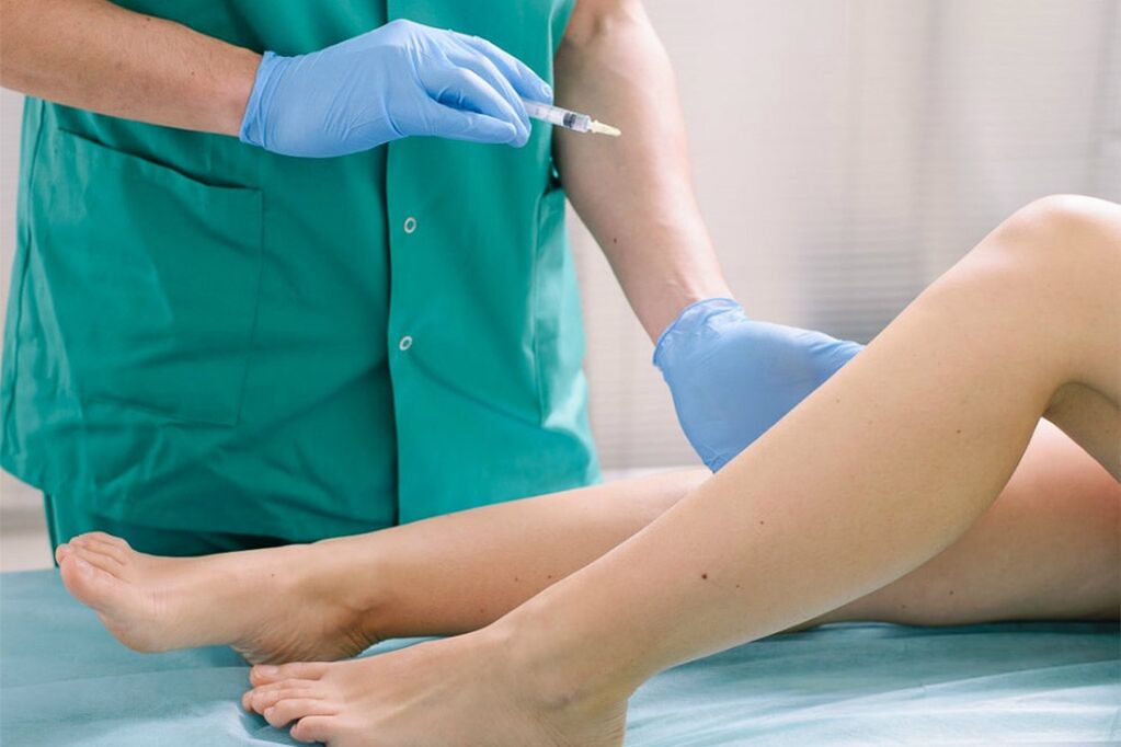 sclerotherapy for the removal of varicose veins