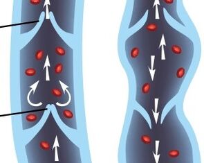 functioning of the valvular apparatus of the veins of the lower extremities