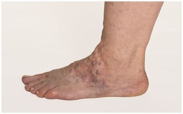 Varicose veins on a man's leg, complicated by trophic ulcers