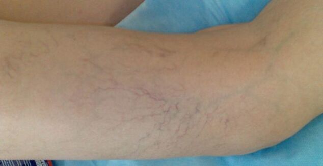 Varicose veins on the legs