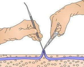 Miniflebectomy - removal of the part of the vein affected by varicose veins