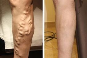 The result of the operation to eliminate varicose veins in the legs