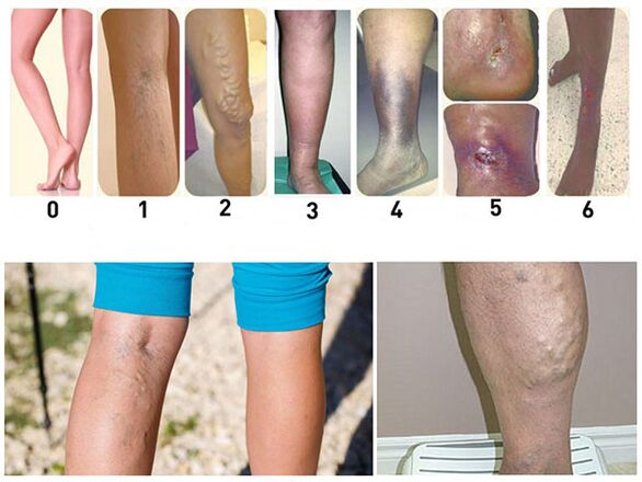 Development stages of varicose veins of the lower limbs