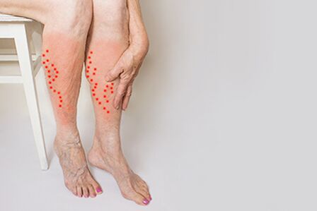 Burning and feeling of heaviness in the legs - symptoms of varicose veins