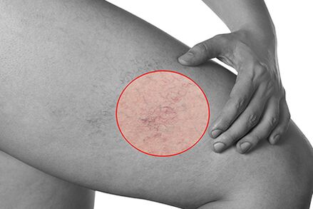 Telangiectasia in the varicose veins of the lower limbs