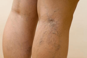 photo of varicose veins on the legs